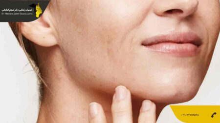 تزریق چربی به خط خنده