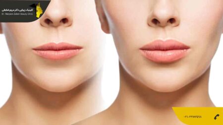 تزریق چربی به لب