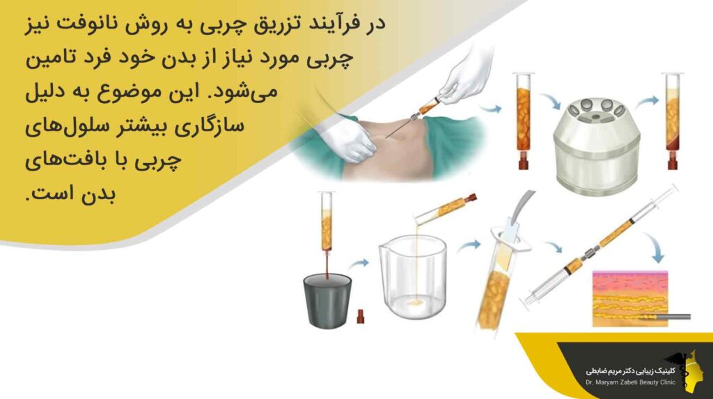 تزریق چربی نانوفت