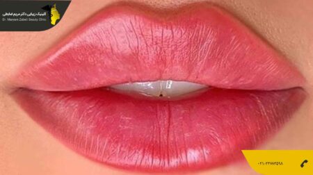 تزریق ژل لب مدل عروسکی یا باربی