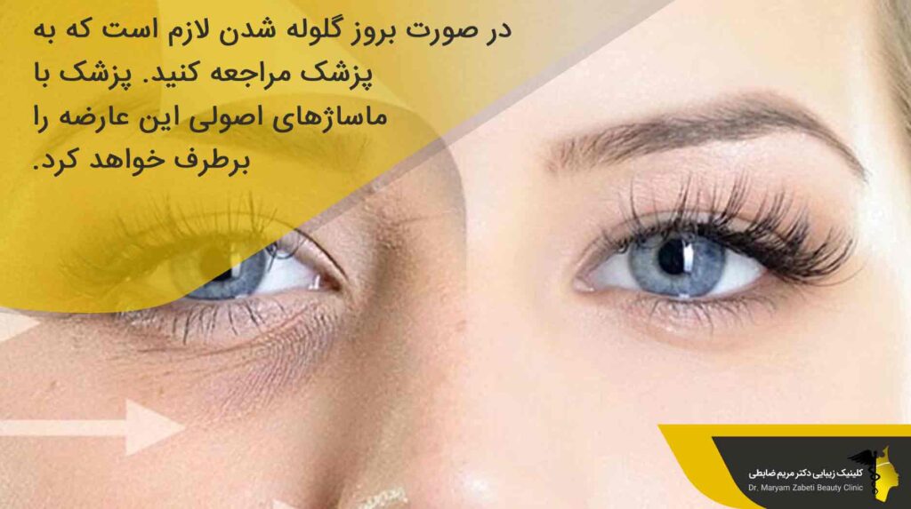 درمان گلوله شدن ژل زیر چشم