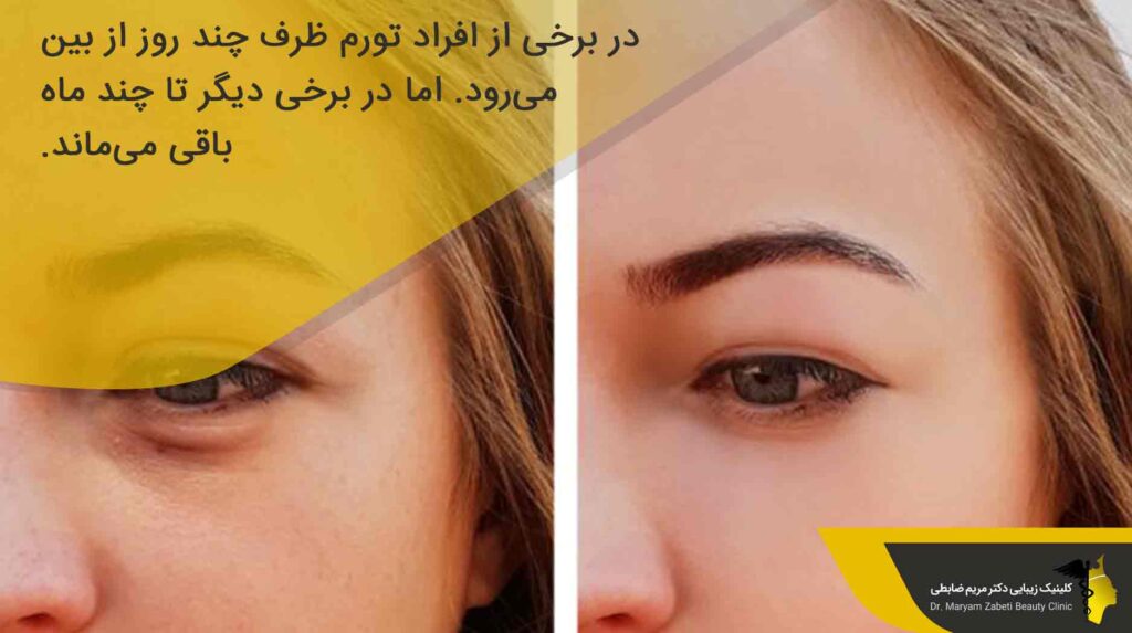 دوره نقاهت تزریق چربی زیر چشم