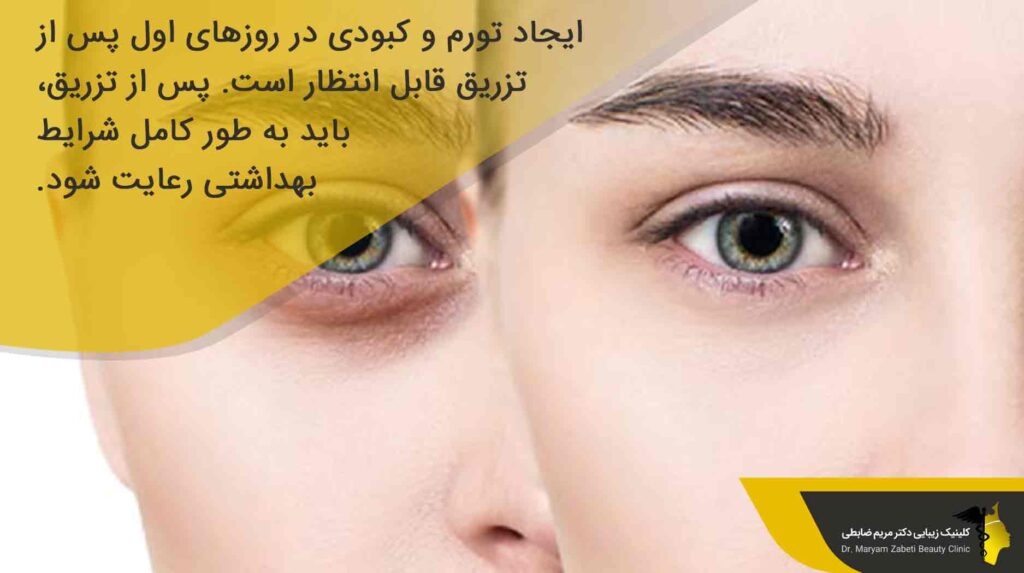 دوره نقاهت تزریق ژل زیر چشم