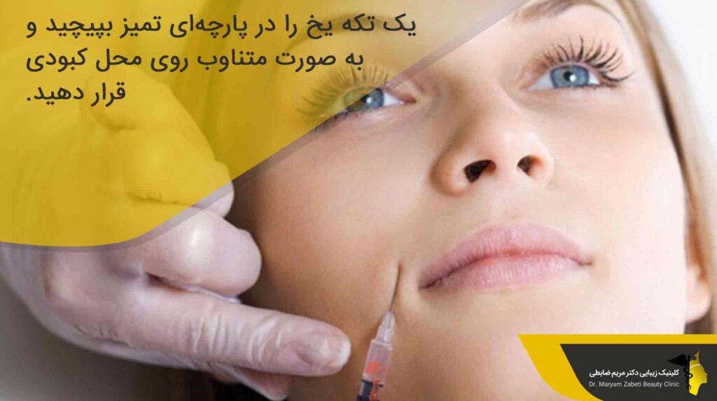 رفع کبودی بعد از تزریق ژل خط خنده
