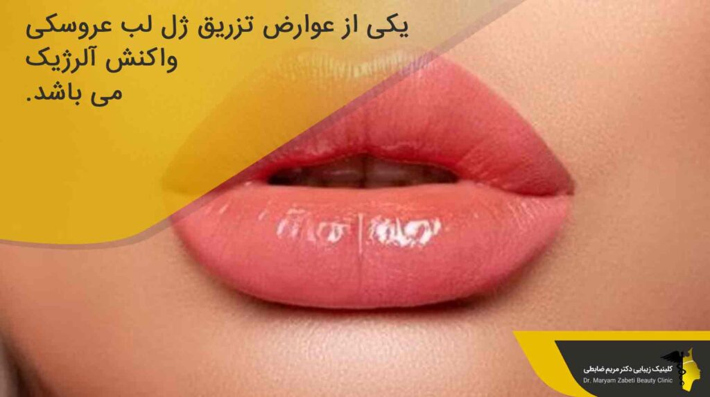 عوارض تزریق ژل لب عروسکی