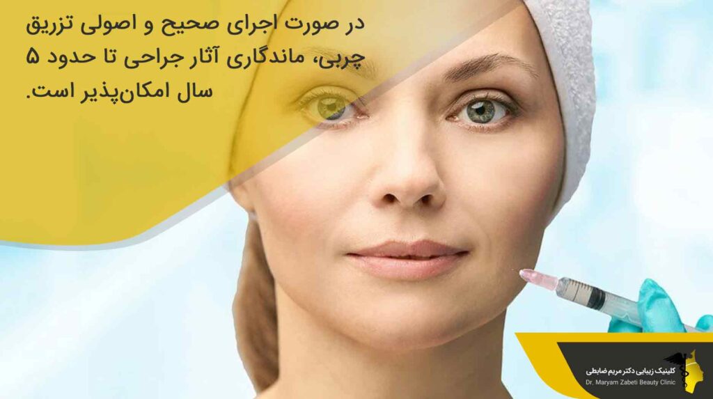 ماندگاری تزریق چربی به خط خنده 