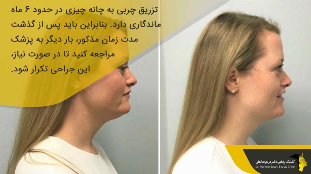 ماندگاری تزریق چربی به چانه 