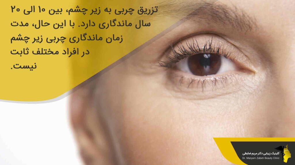 ماندگاری تزریق چربی زیر چشم