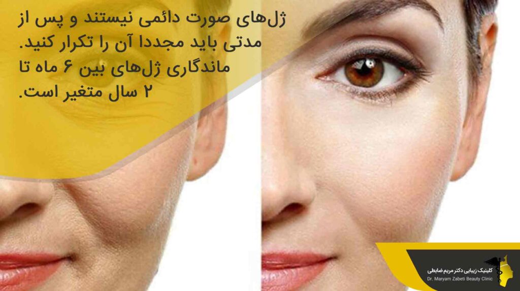 ماندگاری تزریق ژل
