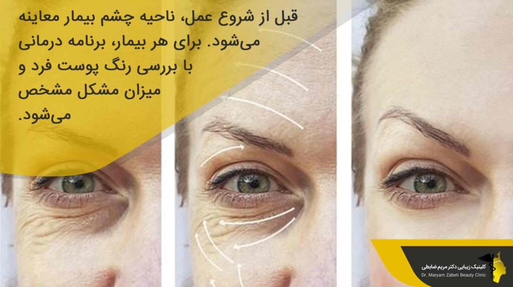 نحوه تزریق فیلر زیر چشم