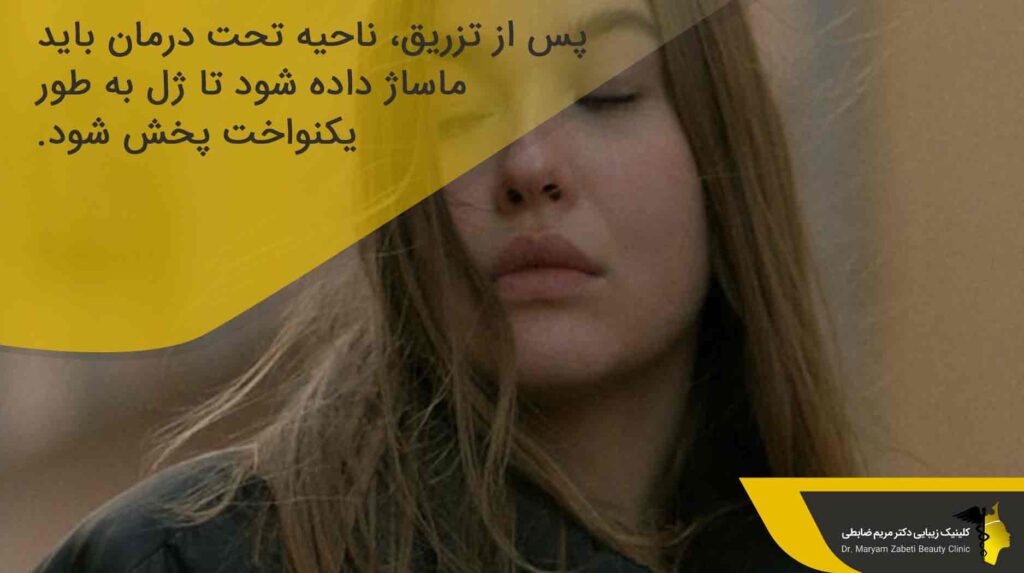 نحوه تزریق ژل لب مدل روسی