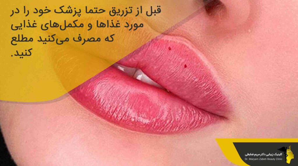 نکات مهم پیش از تزریق ژل لب