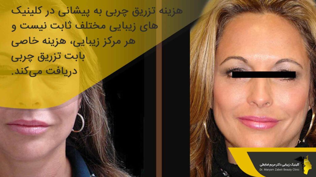 هزینه تزریق چربی به پیشانی
