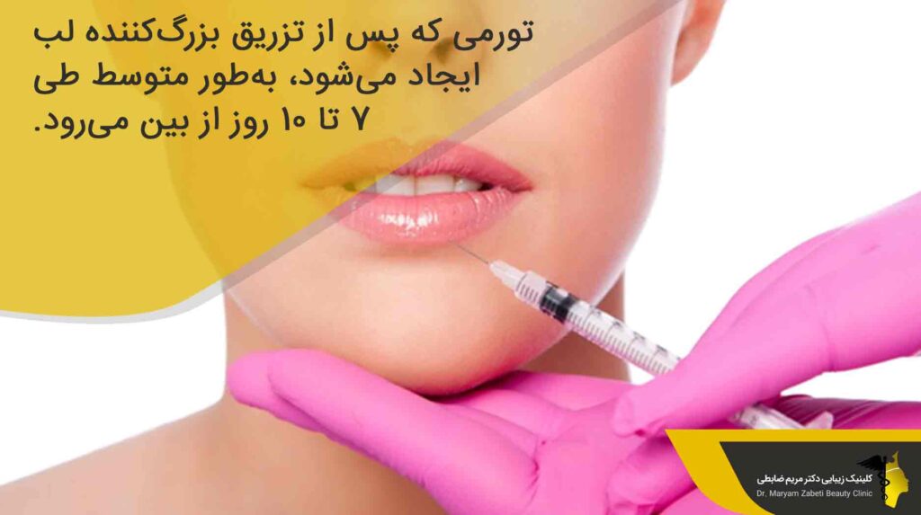  تورم لب بعد از تزریق ژل لب