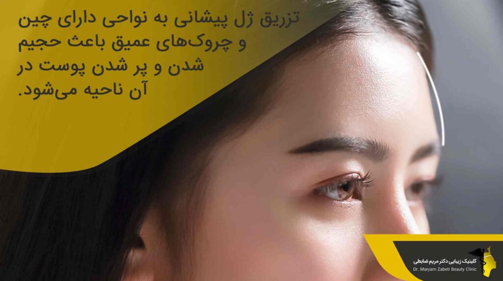 ژل پیشانی چیست؟
