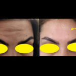 Botox-Nemonekar-Img