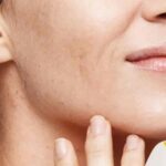 تزریق چربی به خط خنده